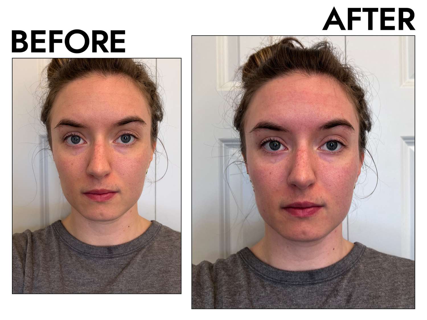 Microneedling Can Reduce Scars and Wrinkles—We Tested and Found the Best Derm Rollers to DIY the Treatment (10)