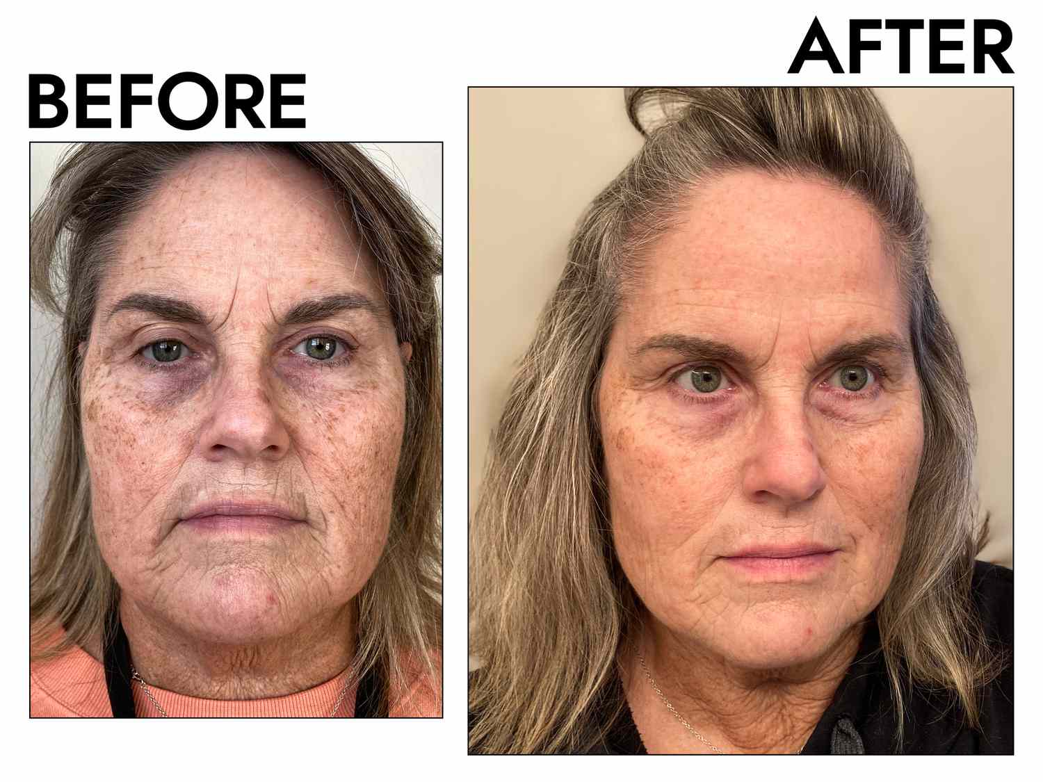 Microneedling Can Reduce Scars and Wrinkles—We Tested and Found the Best Derm Rollers to DIY the Treatment (8)